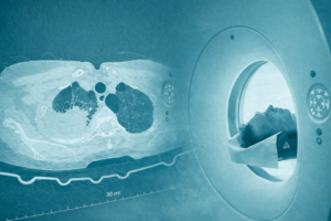 Lungenkrebs-Screening_May_DRG_Original_Coverbild